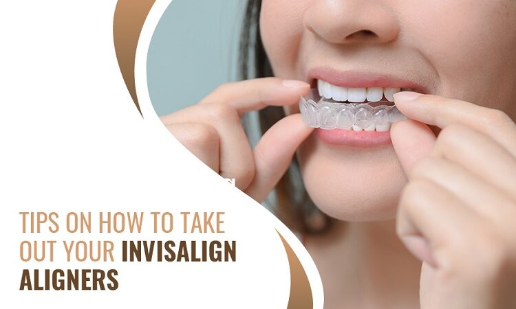 Tips on How to Take Out Your Invisalign Aligners
