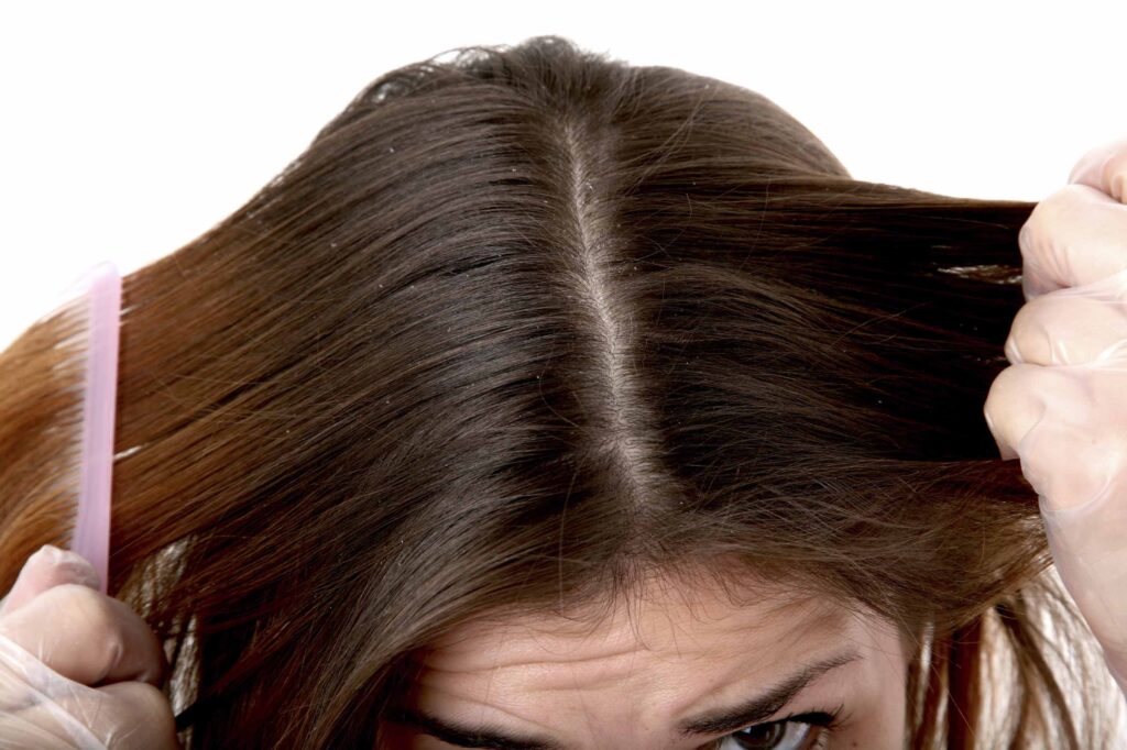 Decoding Dandruff